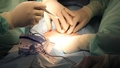 Ārsti Indijā izoperējuši milzu nieri, kas svērusi 7,4 kilogramus