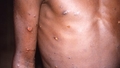 11 valstīs reģistrēti aptuveni 80 pērtiķu baku gadījumi. Kas jāzina par šo infekcijas slimību?